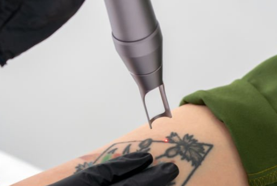 Is Laser Tattoo Removal Risky - 1
