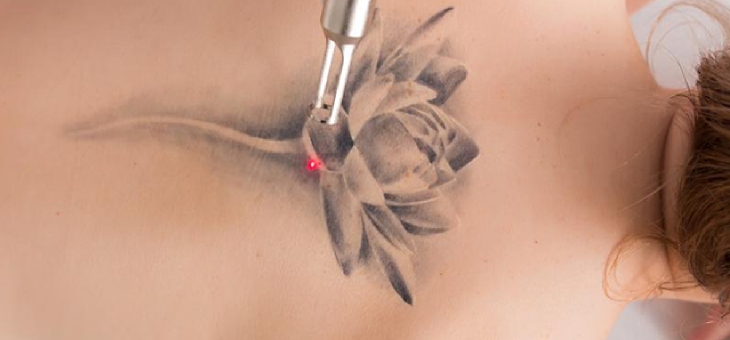 Laser tattoo removal blog 02, Begone Skin & Body Perth